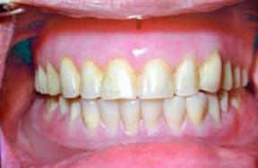 denture-02-after