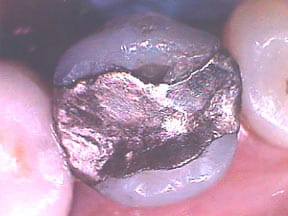 fillings-02-before