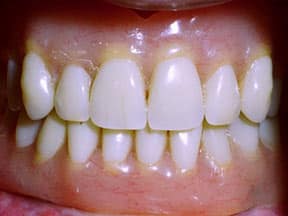 implant-04-after