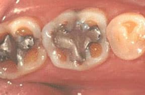 porcelain-crowns-before-1