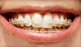 six month smiles clear braces with a Clovis dentist in Fresno CA